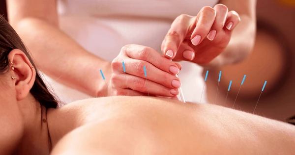 Dry Needling Therapy